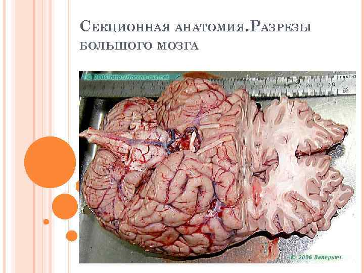 СЕКЦИОННАЯ АНАТОМИЯ. РАЗРЕЗЫ БОЛЬШОГО МОЗГА 