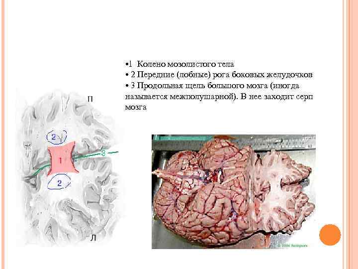  • 1 Колено мозолистого тела • 2 Передние (лобные) рога боковых желудочков •