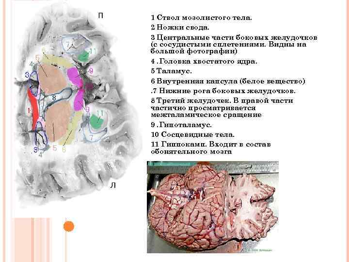 1 Ствол мозолистого тела. 2 Ножки свода. 3 Центральные части боковых желудочков (с сосудистыми