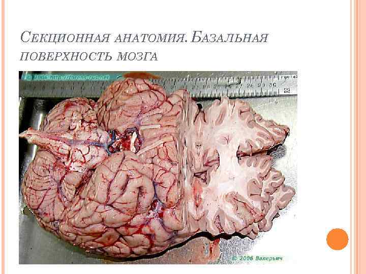 СЕКЦИОННАЯ АНАТОМИЯ. БАЗАЛЬНАЯ ПОВЕРХНОСТЬ МОЗГА 