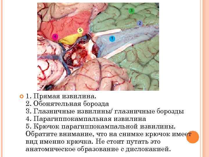  1. Прямая извилина. 2. Обонятельная борозда 3. Глазничные извилины/ глазничные борозды 4. Парагиппокампальная