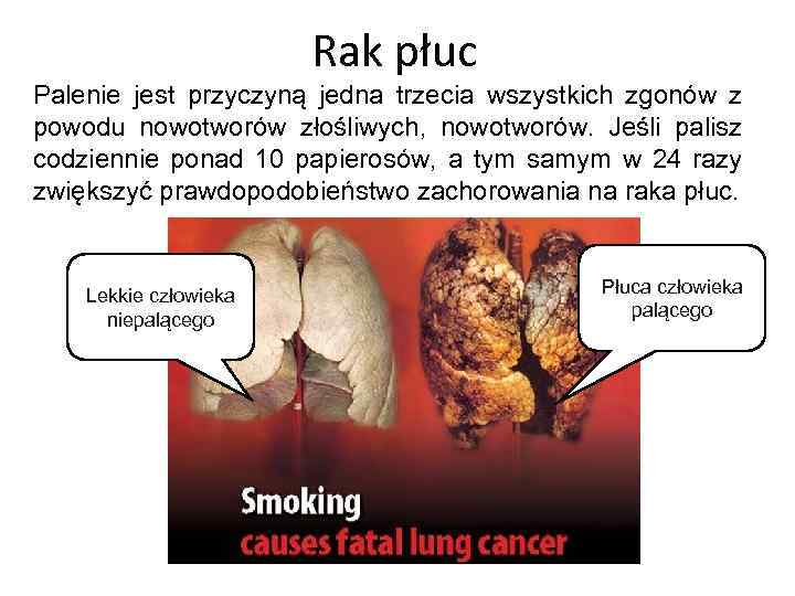 Rak płuc Palenie jest przyczyną jedna trzecia wszystkich zgonów z powodu nowotworów złośliwych, nowotworów.