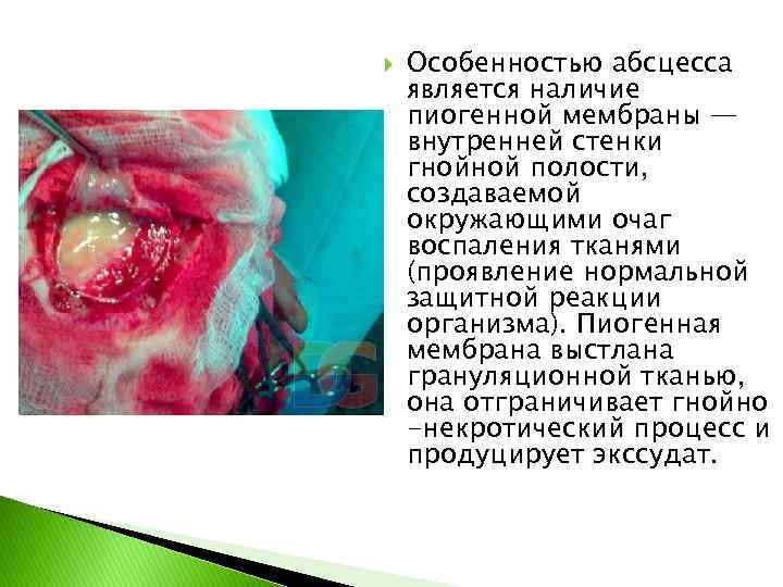  Особенностью абсцесса является наличие пиогенной мембраны — внутренней стенки гнойной полости, создаваемой окружающими