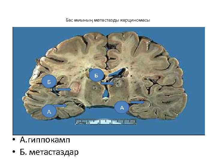 Бас миының метастазды карциномасы • А. гиппокамп • Б. метастаздар 