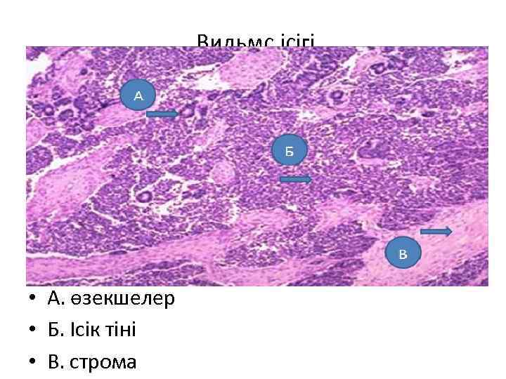  Вильмс ісігі • А. өзекшелер • Б. Ісік тіні • В. строма 