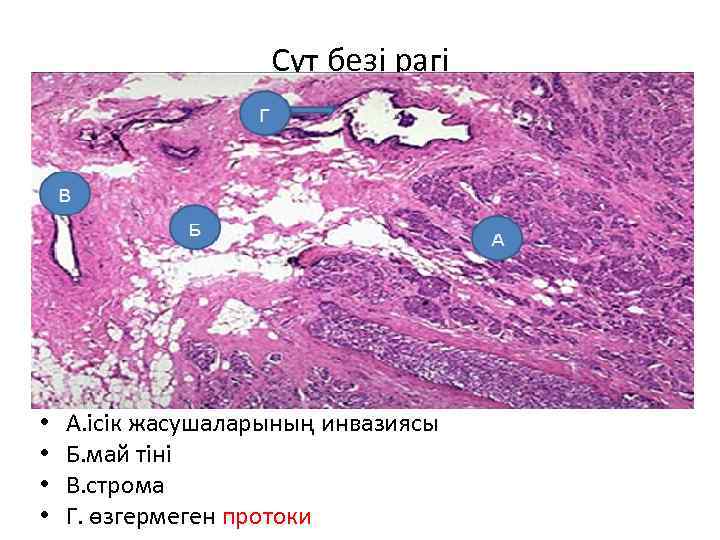 Сүт безі рагі • • А. ісік жасушаларының инвазиясы Б. май тіні В. строма