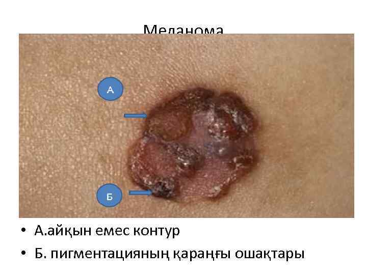 Меланома • А. айқын емес контур • Б. пигментацияның қараңғы ошақтары 