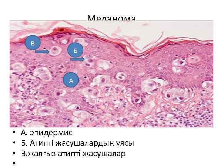 Меланома • • А. эпидермис Б. Атипті жасушалардың ұясы В. жалғыз атипті жасушалар 