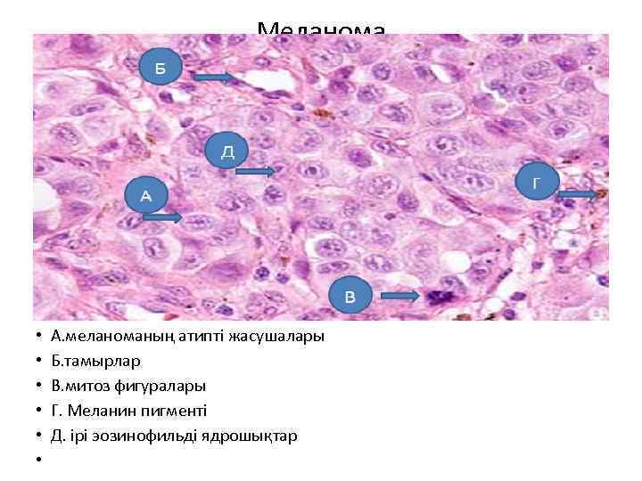 Меланома • • • А. меланоманың атипті жасушалары Б. тамырлар В. митоз фигуралары Г.