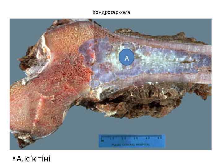 Хондросаркома • А. Ісік тіні 