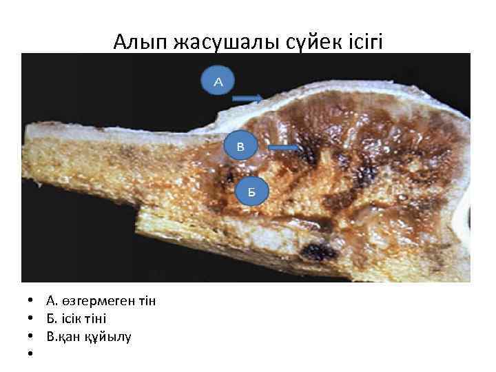 Алып жасушалы сүйек ісігі • • А. өзгермеген тін Б. ісік тіні В. қан