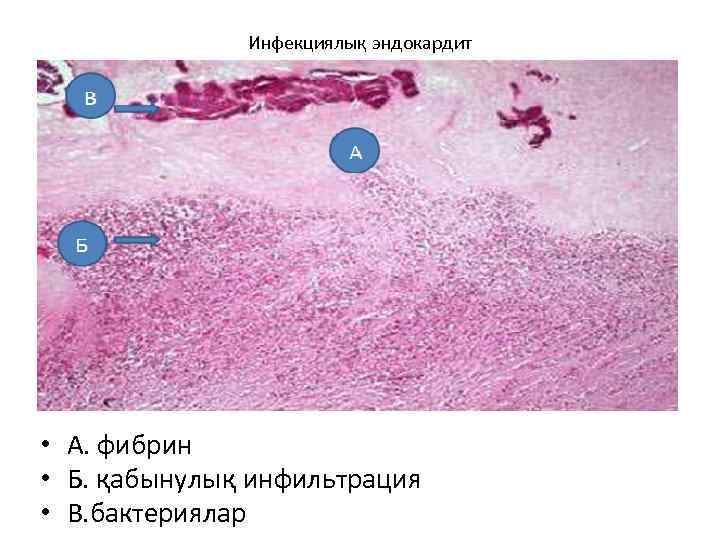 Инфекциялық эндокардит • А. фибрин • Б. қабынулық инфильтрация • В. бактериялар 