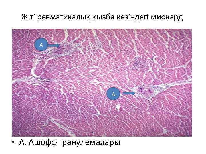 Жіті ревматикалық қызба кезіндегі миокард • А. Ашофф гранулемалары 