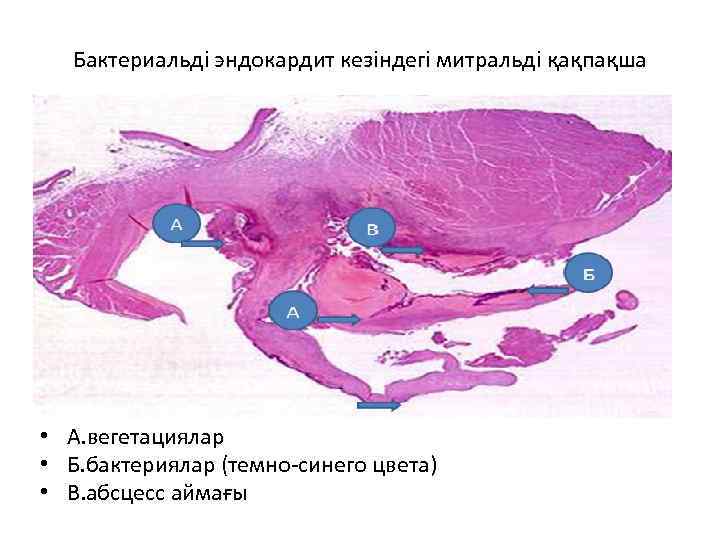 Бактериальді эндокардит кезіндегі митральді қақпақша • А. вегетациялар • Б. бактериялар (темно-синего цвета) •