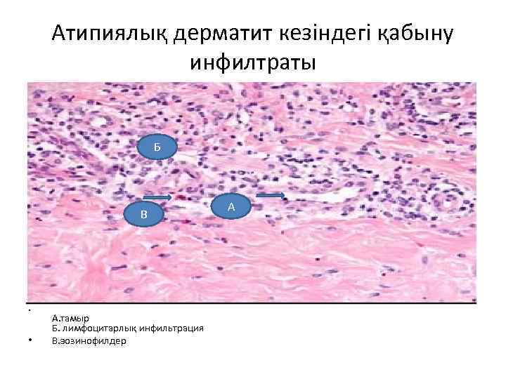 Атипиялық дерматит кезіндегі қабыну инфилтраты Б В • • А. тамыр Б. лимфоцитарлық инфильтрация