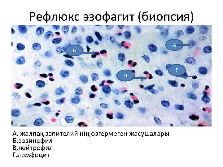 Рефлюкс эзофагит (биопсия) А Б В А. жалпақ зэпителийінің өзгермеген жасушалары Б. эозинофил В.