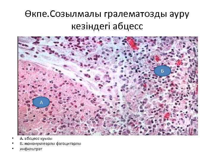 Өкпе. Созылмалы гралематозды ауру кезіндегі абцесс Б А • • • А. абсцесс қуысы