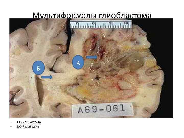 Мультиформалы глиобластома • • А. Глиобластома Б. Сүйелді дене 