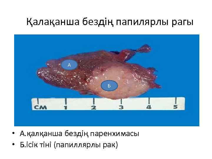 Қалақанша бездің папилярлы рагы А Б • А. қалқанша бездің паренхимасы • Б. ісік