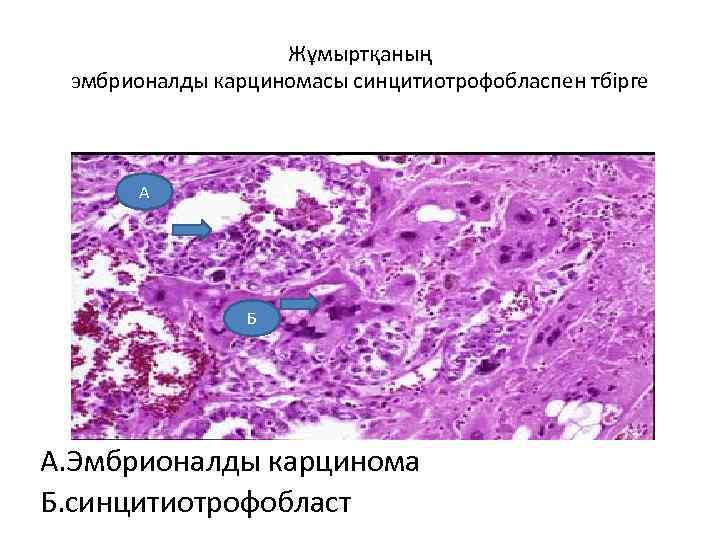 Жұмыртқаның эмбрионалды карциномасы синцитиотрофобласпен тбірге А Б А. Эмбрионалды карцинома Б. синцитиотрофобласт 