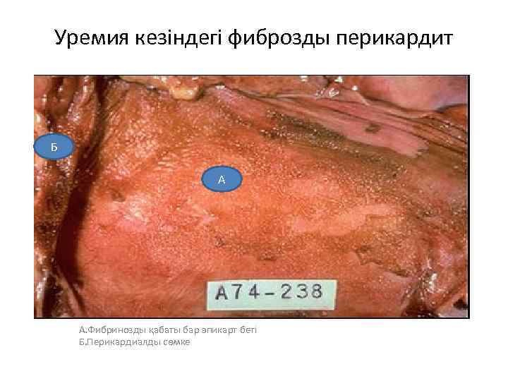 Уремия кезіндегі фиброзды перикардит Б А А. Фибринозды қабаты бар эпикарт беті Б. Перикардиалды