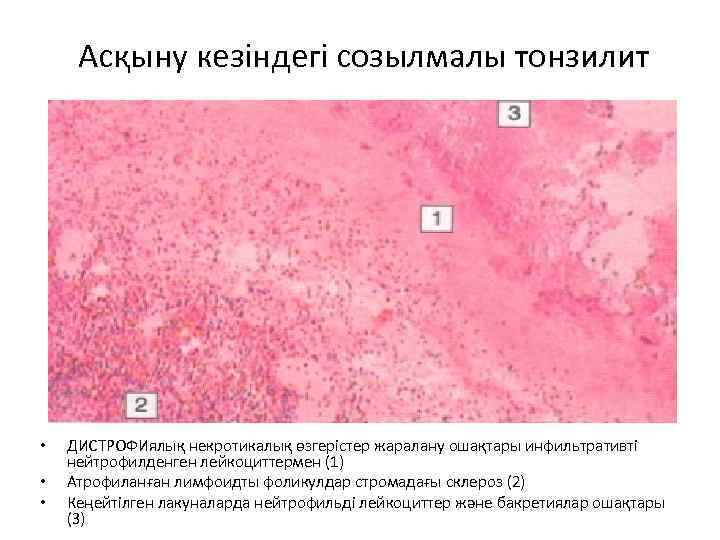  Асқыну кезіндегі созылмалы тонзилит • • • ДИСТРОФИялық некротикалық өзгерістер жаралану ошақтары инфильтративті