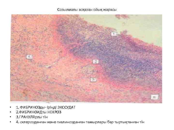 Созылмалы асқазан ойық жарасы • • 1. ФИБРИНОЗды- іріңді ЭКССУДАТ 2. ФИБРИНОИДты НЕКРОЗ 3.