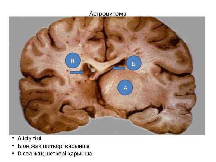 Астроцитома • А. ісік тіні • Б. оң жақ шеткері қарынша • В. сол