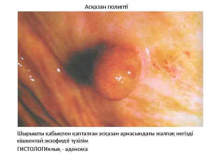 Асқазан полипті Шырышты қабықпен қапталған асқазан арнасындағы жалпақ негізді кішкентай экзофидті түзілім ГИСТОЛОГИялық -