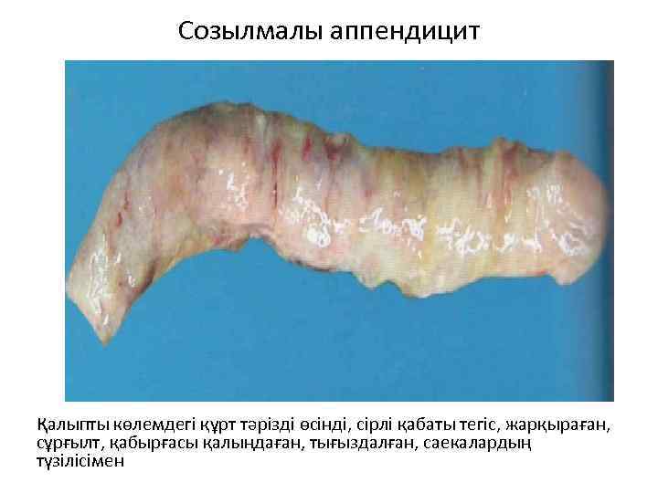 Созылмалы аппендицит Қалыпты көлемдегі құрт тәрізді өсінді, сірлі қабаты тегіс, жарқыраған, сұрғылт, қабырғасы қалыңдаған,