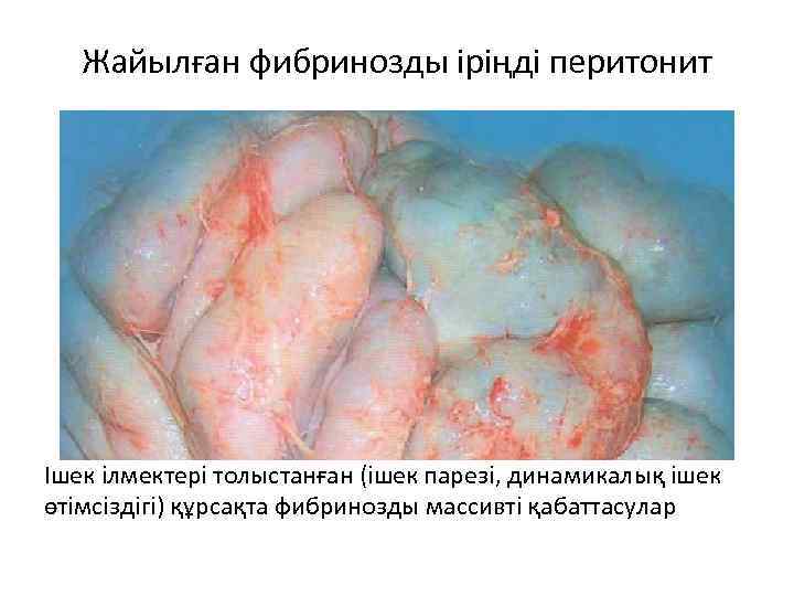 Жайылған фибринозды іріңді перитонит Ішек ілмектері толыстанған (ішек парезі, динамикалық ішек өтімсіздігі) құрсақта фибринозды