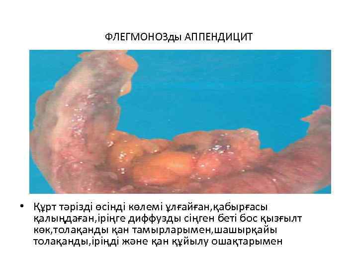ФЛЕГМОНОЗды АППЕНДИЦИТ • Құрт тәрізді өсінді көлемі ұлғайған, қабырғасы қалыңдаған, іріңге диффузды сіңген беті