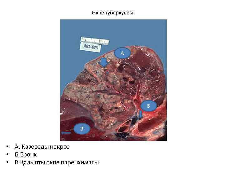 Өкпе туберкулезі А Б В • А. Казеозды некроз • Б. Бронх • В.