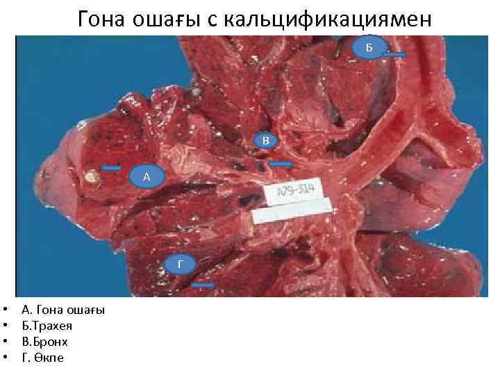  Гона ошағы с кальцификациямен Б В А Г • • А. Гона ошағы