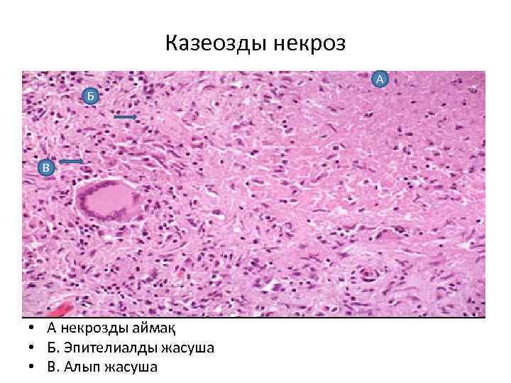 Казеозды некроз А Б В • А некрозды аймақ • Б. Эпителиалды жасуша •