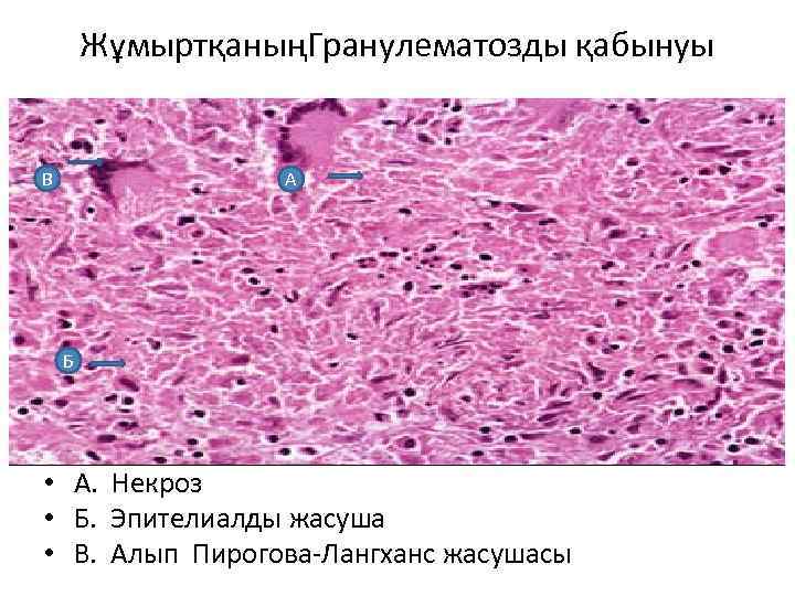 ЖұмыртқаныңГранулематозды қабынуы В А Б • А. Некроз • Б. Эпителиалды жасуша • В.