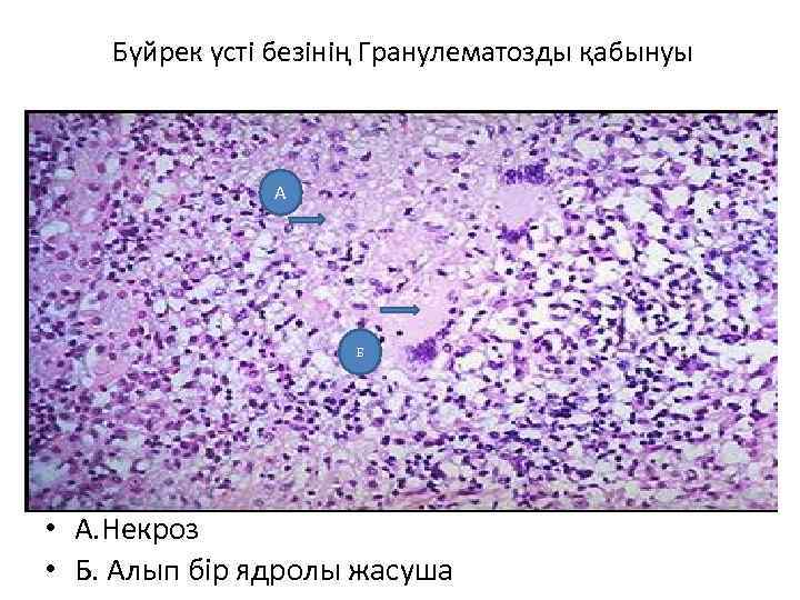  Бүйрек үсті безінің Гранулематозды қабынуы А Б • А. Некроз • Б. Алып