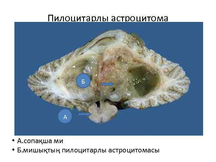 Пилоцитарлы астроцитома • А. сопақша ми • Б. мишықтың пилоцитарлы астроцитомасы 