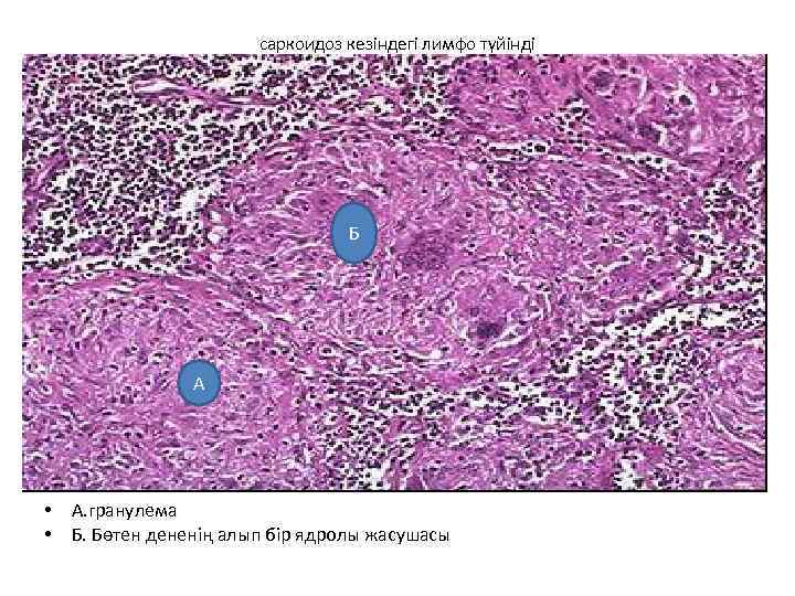 саркоидоз кезіндегі лимфо түйінді Б А • • А. гранулема Б. Бөтен дененің алып