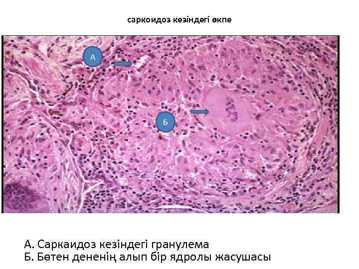 саркоидоз кезіндегі өкпе А Б А. Саркаидоз кезіндегі гранулема Б. Бөтен дененің алып бір