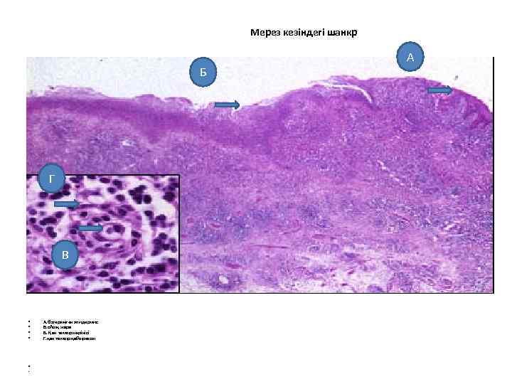 Мерез кезіндегі шанкр Б Г В • • А. Өзгермеген эпидермис Б. ойық жара