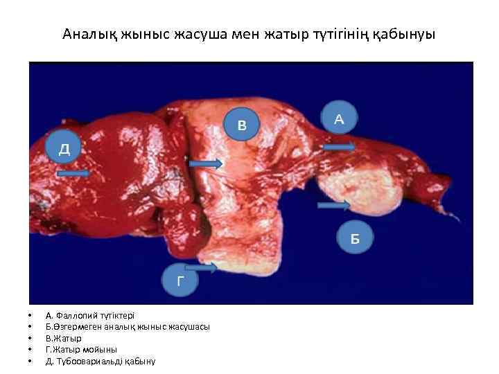 Аналық жыныс жасуша мен жатыр түтігінің қабынуы • • • А. Фаллопий түтіктері Б.