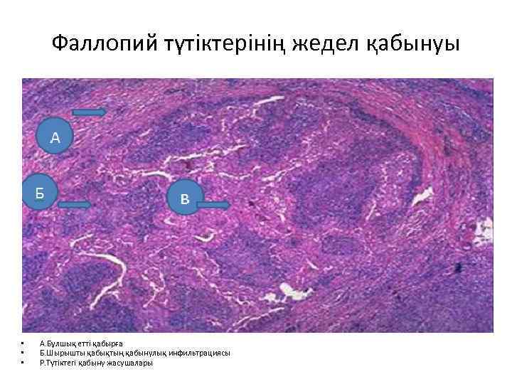 Фаллопий түтіктерінің жедел қабынуы • • • А. Бұлшық етті қабырға Б. Шырышты қабықтың