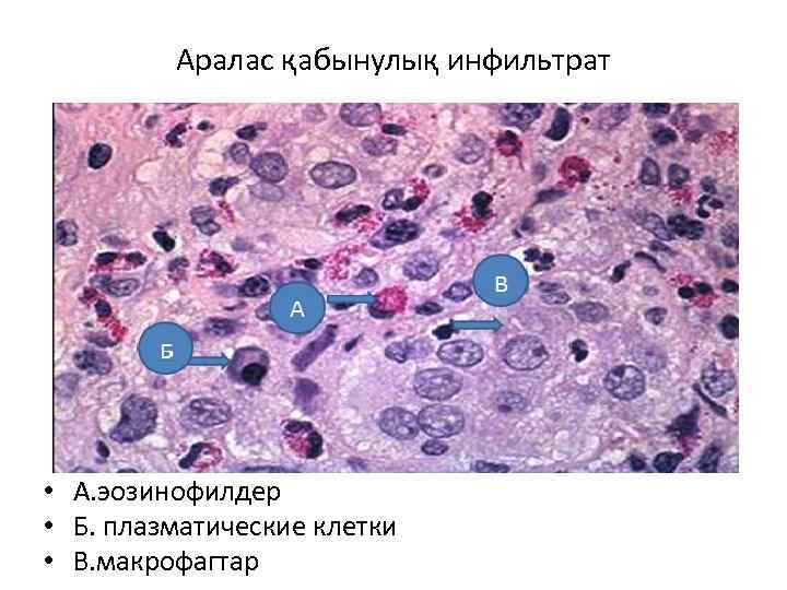 Аралас қабынулық инфильтрат • А. эозинофилдер • Б. плазматические клетки • В. макрофагтар 