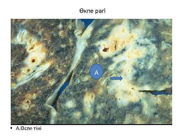 Өкпе рагі • А. Өспе тіні 