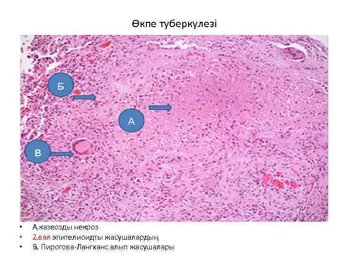 Өкпе туберкулезі • • • А. казеозды некроз 2. вал эпителиоидты жасушалардың В. Пирогова-Лангханс