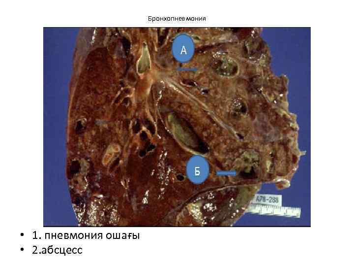 Бронхопневмония • 1. пневмония ошағы • 2. абсцесс 