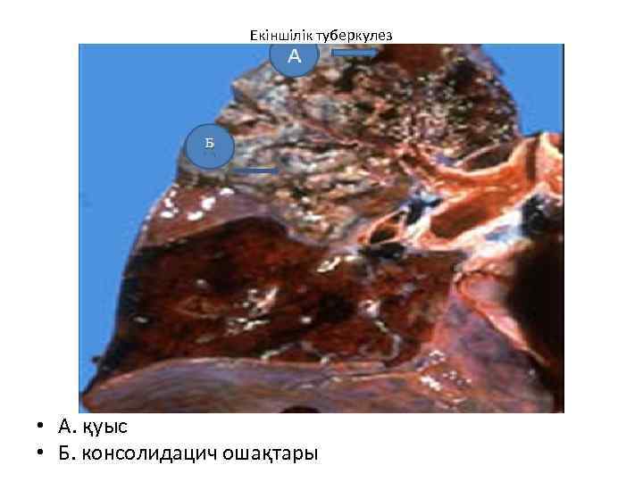 Екіншілік туберкулез • А. қуыс • Б. консолидацич ошақтары 