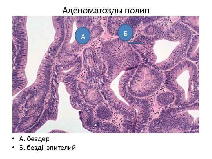 Аденоматозды полип Аденоматозный полип А. Железы Б. железистый эпителий • А. бездер • Б.
