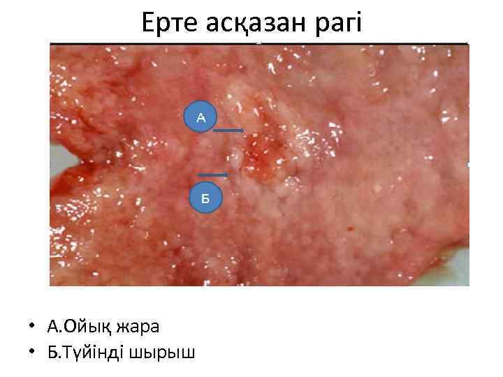 Ерте асқазан рагі • А. Ойық жара • Б. Түйінді шырыш 
